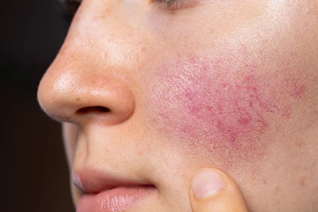 Which ingredients in skincare products should you avoid if you have rosacea?